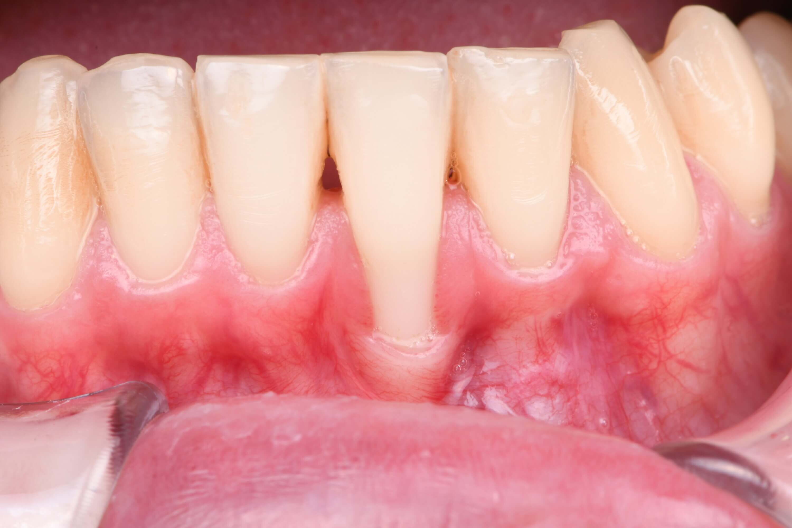 Cirurgia plastica peridontal - Recobrimento radicular