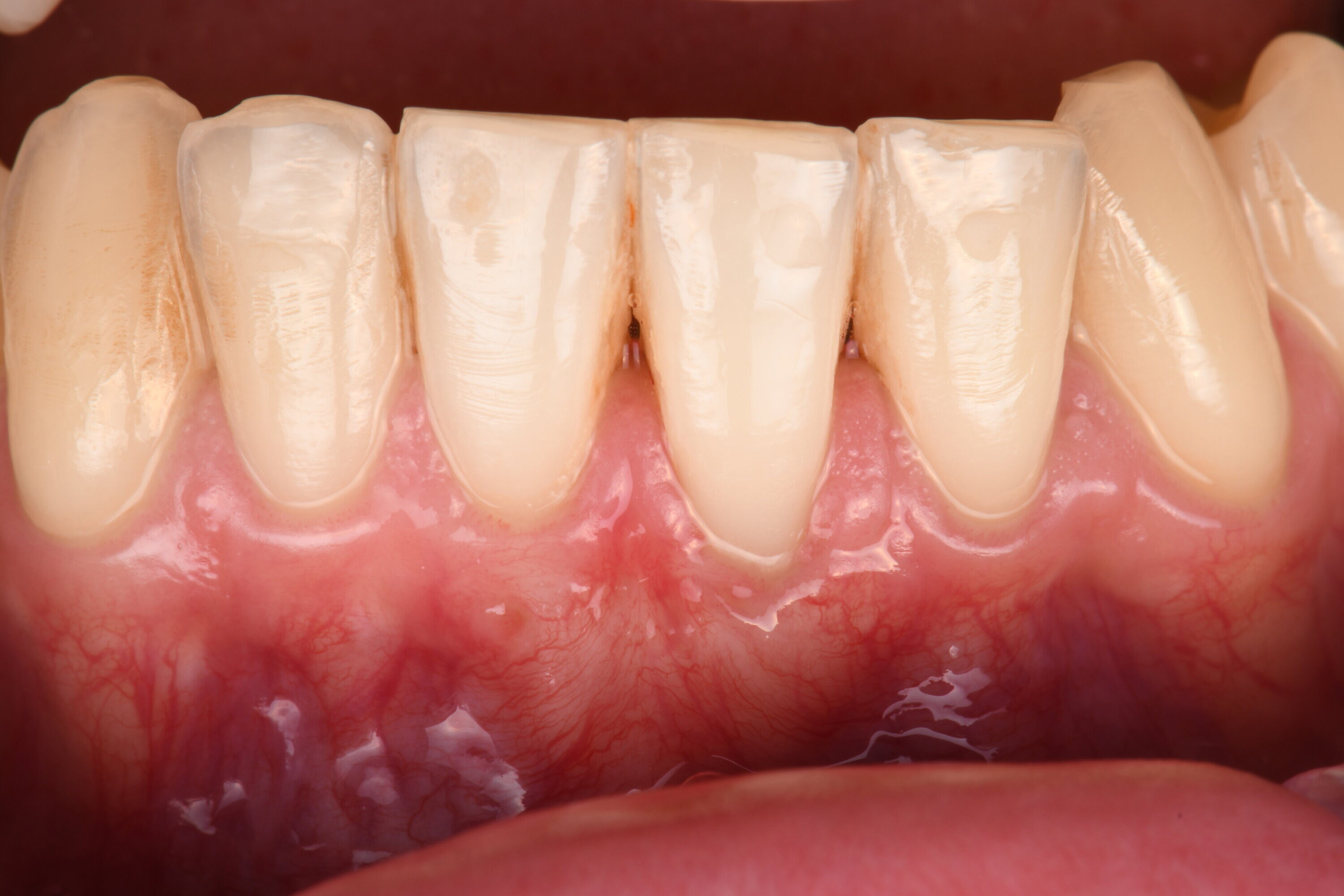 Cirurgia plastica peridontal - Recobrimento radicular