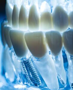 implantes dentários Aveiro implantologia Aveiro