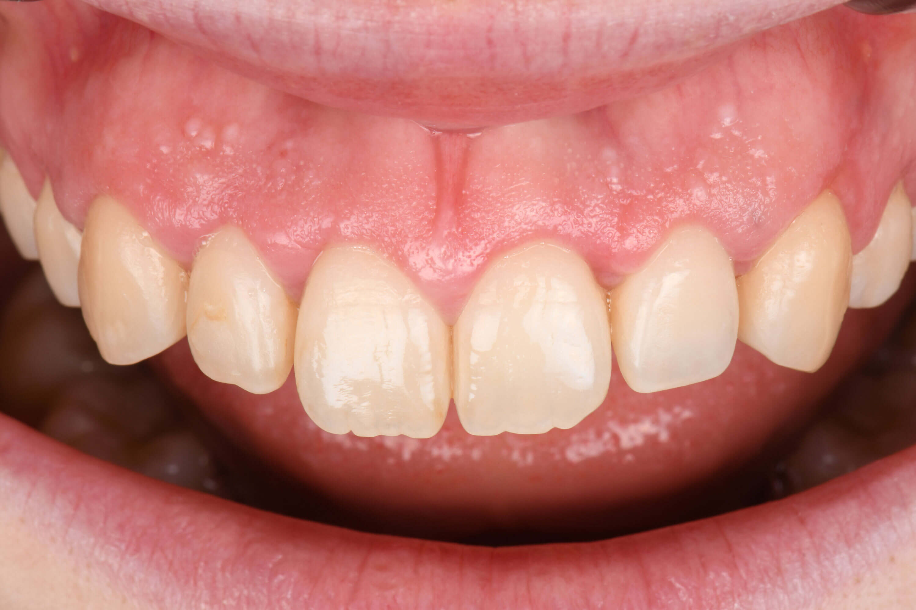 Periodontal plastic surgery — Aesthetic crown lengthening — Altered passive eruption (Coslet 1B) — upper anterior sector.