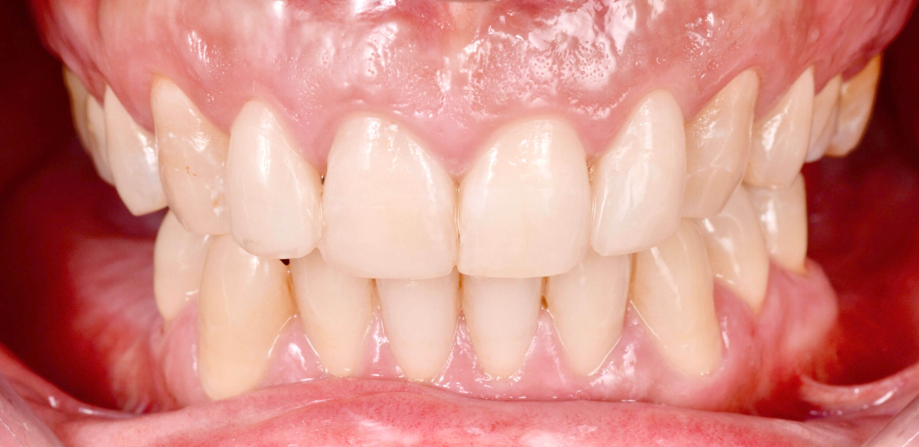 Antes e depois branqueamento dentário