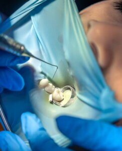 desvitalizar um dente, tratamento de canal, tratamento endodôntico, quando desvitalizar um dente, desvitalização dói, root canal, pulpite, necrose pulpar, abcesso dentário, desvitalização ou extracção, dentista Aveiro, endodontia Aveiro